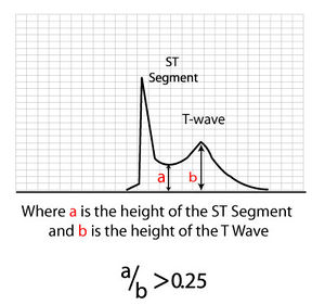 ST-T ratio.jpg